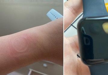 Расхваленные журналистами умные часы Apple Watch SE перегреваются и выходят из строя. Уже есть как минимум шесть идентичных случаев