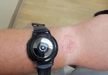 Опасные технологии: пользователь получил ожог от умных часов Samsung Galaxy Watch