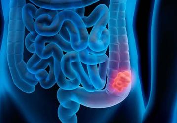 Ученые победили рак прямой кишки: передовой препарат Dostarlimab полностью излечил рак прямой кишки у всех участников испытаний