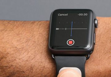 Браслет AliveCor Kardia для часов Apple Watch позволит за минуту снять ЭКГ и отправит данные врачу, если результаты вызывают опасения