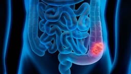 Ученые победили рак прямой кишки: передовой препарат Dostarlimab полностью излечил рак прямой кишки у всех участников испытаний