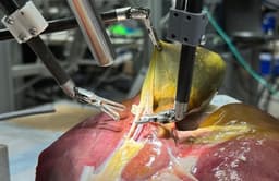 Учёные Джонса Хопкинса создали робота, самостоятельно удалившего желчный пузырь на симуляторе